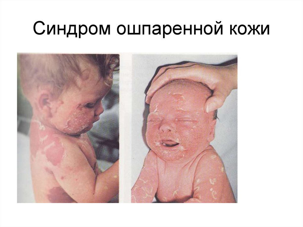 Синдром ошпаренной кожи