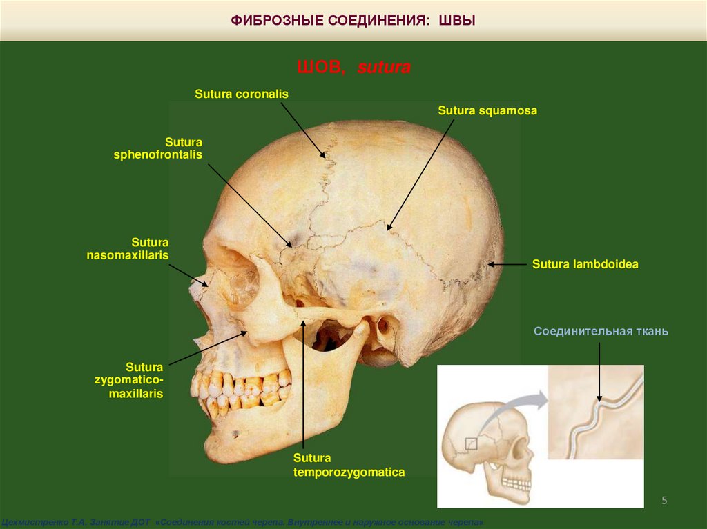 Кости и швы черепа