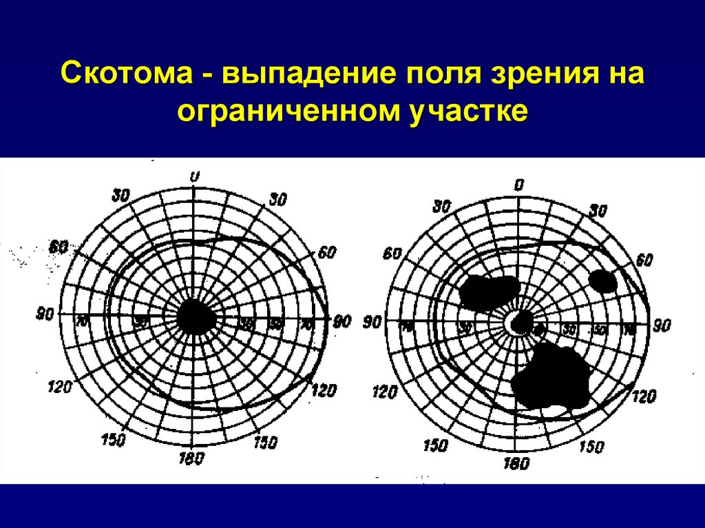 Периметрия расшифровка. Центральная скотома периметрия. Центральные скотомы в поле зрения. Периметрия поля зрения. Скотома Бьеррума.