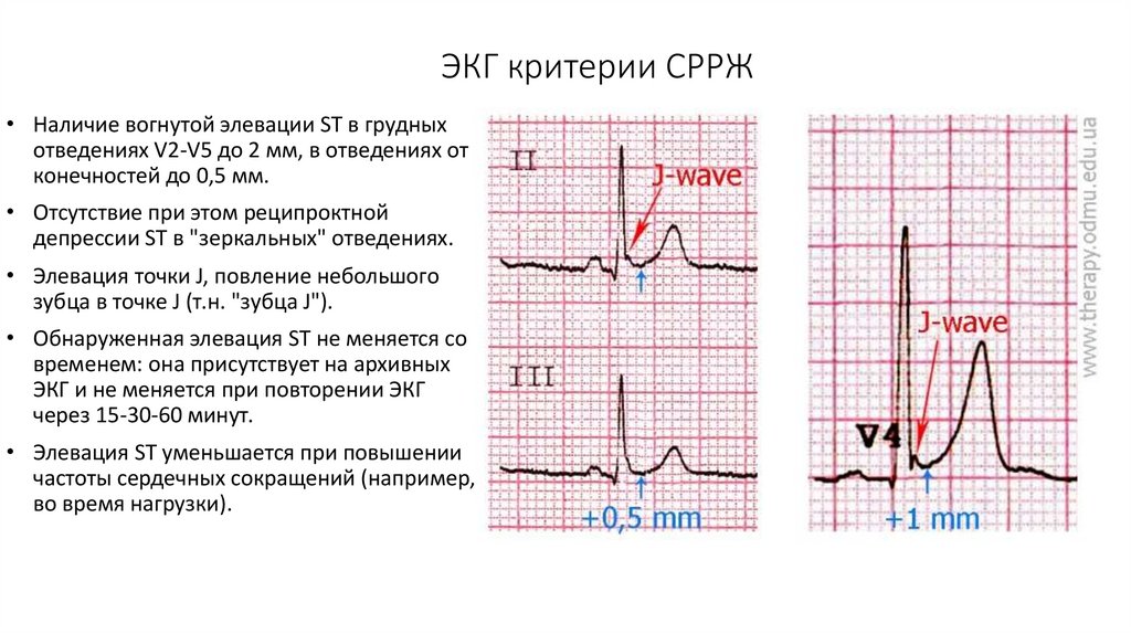 Диффузное нарушение процесса реполяризации сердца. Синдром ранней реполяризации желудочков. Ранняя реполяризация желудочков заключение. Паттерн ранней реполяризации желудочков. Ранняя реполяризация желудочков пример заключения.