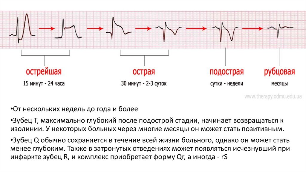 Диффузное нарушение процесса реполяризации сердца