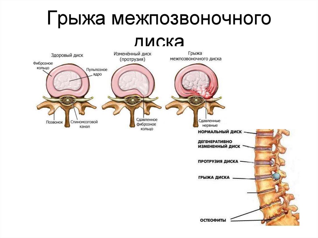 Позвоночный диск