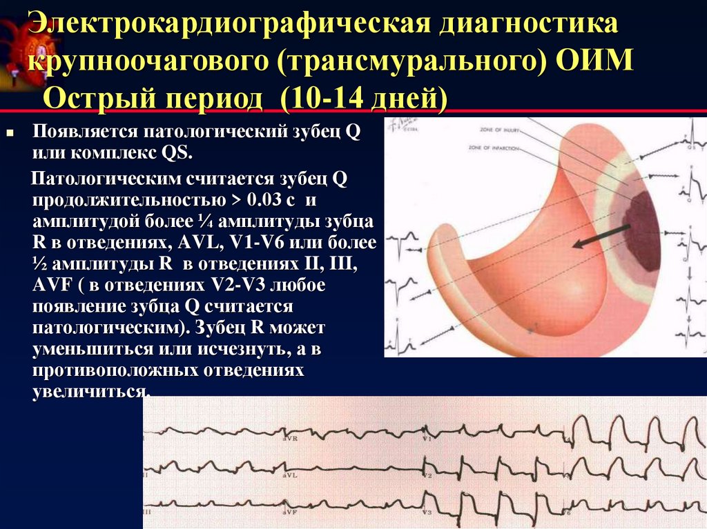 Трансмуральный инфаркт. Крупноочаговый трансмуральный. Острый инфаркт миокарда трансмуральный диагностика. Трансмуральный инфаркт в остром периоде. Патологический зубец q трансмуральный.
