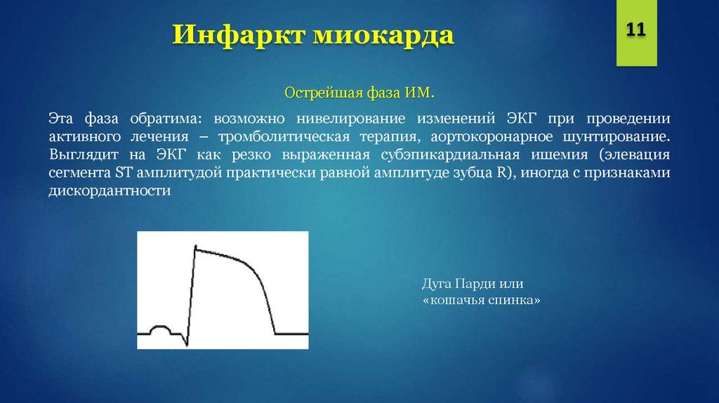 Дискордантных парах. Дискордантные изменения. Ишемия на ЭКГ. Инфаркт миокарда на ЭКГ презентация. Дискордантно в ЭКГ это.