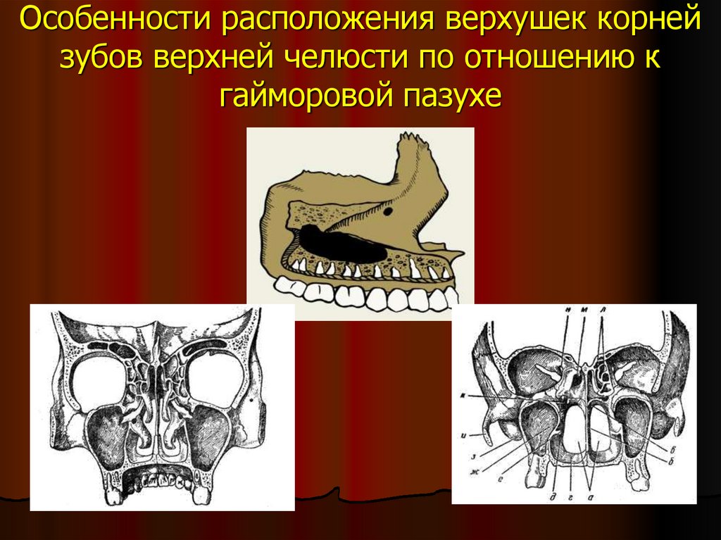 Анатомия верхнечелюстной пазухи презентация