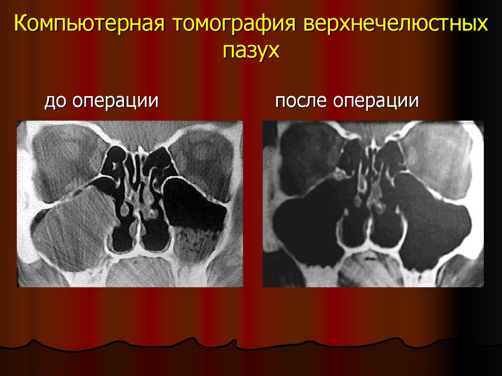 Одонтогенный синусит презентация