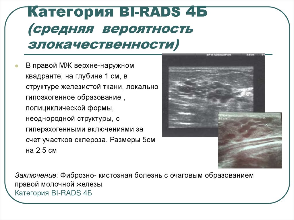 Birads 2 что означает. Бирадс молочной железы по УЗИ классификация. Bi rads УЗИ. Вероятность злокачественности при bi-rads. Bi rads 4 b молочной железы.