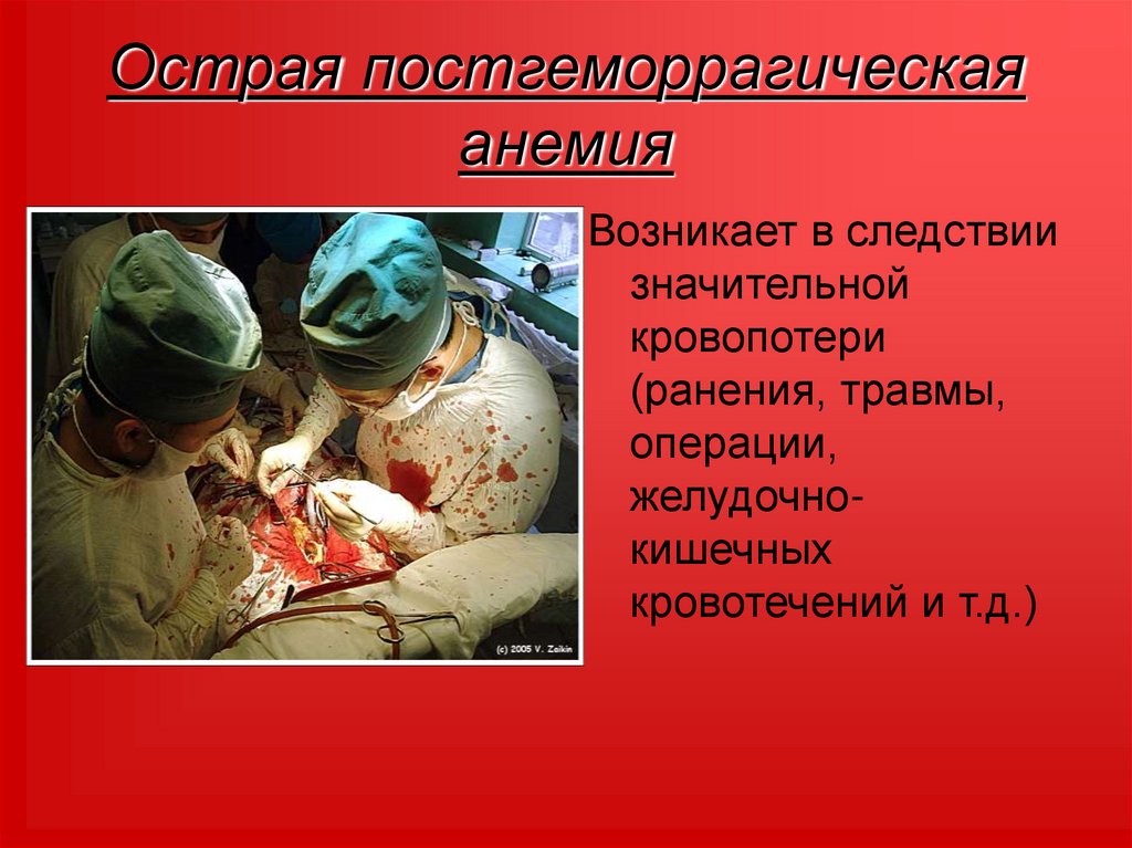 Острая постгеморрагическая анемия