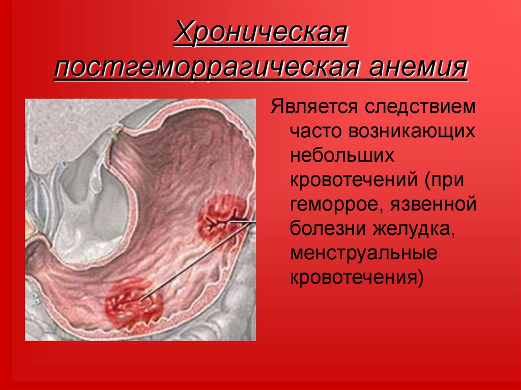 Хроническая постгеморрагическая анемия