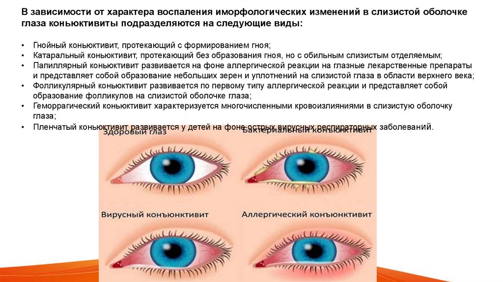 Коньюктивит - online presentation