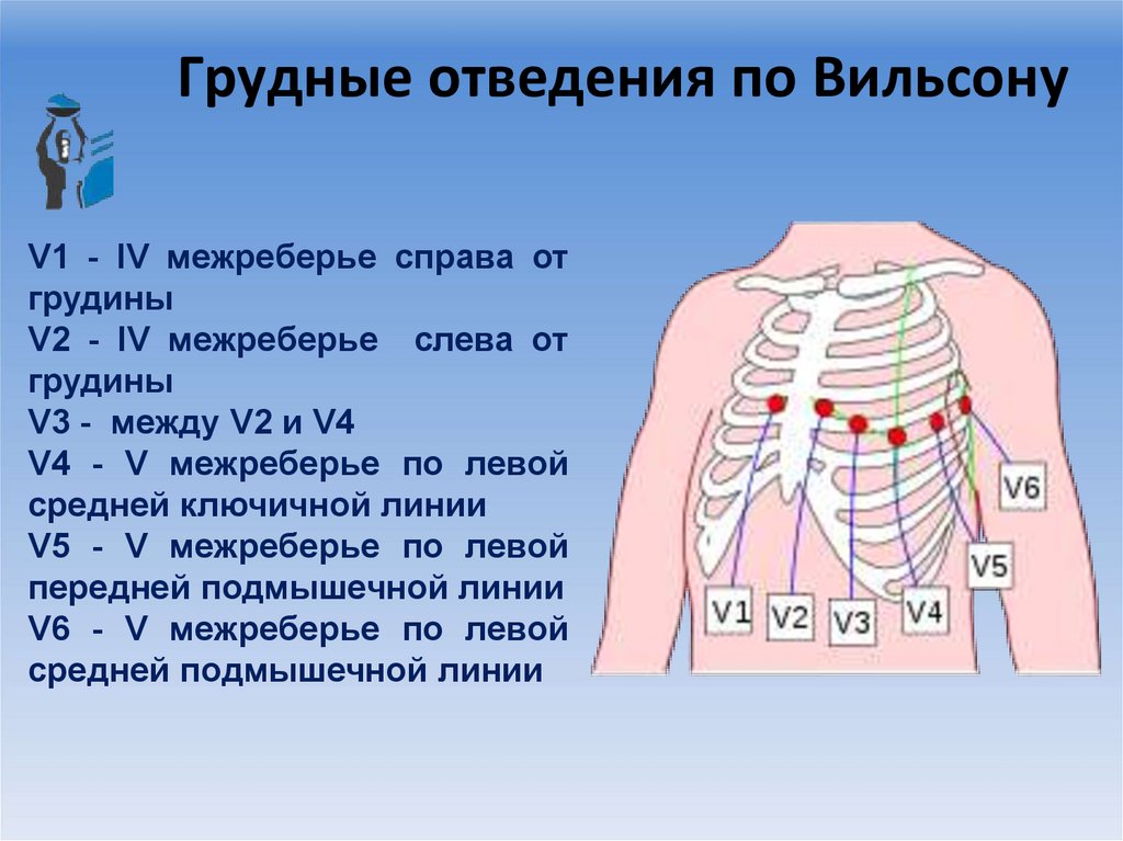 Грудные отведения по Вильсону