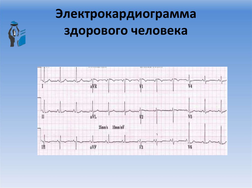 Электрокардиограмма здорового человека