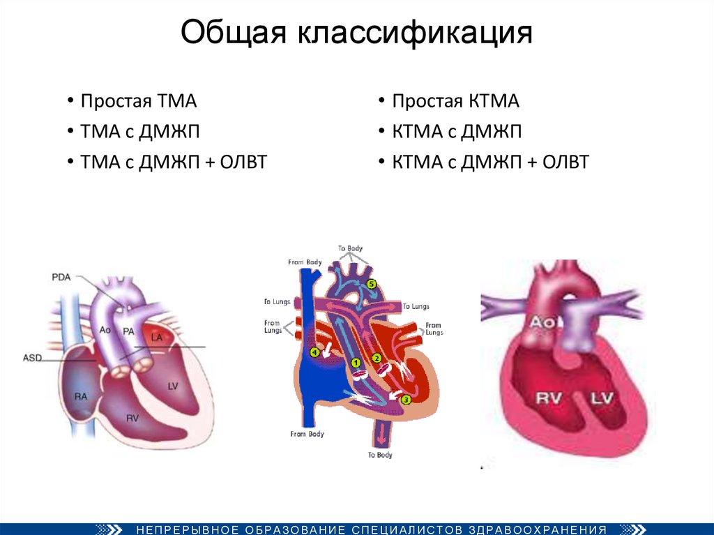 Транспозиция магистральных артерий презентация