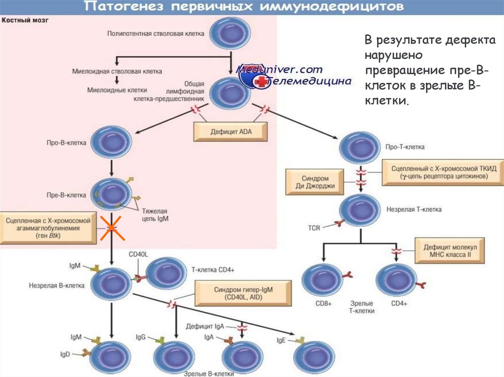 Болезнь брутона. Болезнь Брутона презентация. Синдром Брутона Тип наследования. Агаммаглобулинемия Брутона презентация. Гипоплазия лимфоидной ткани при болезни Брутона.