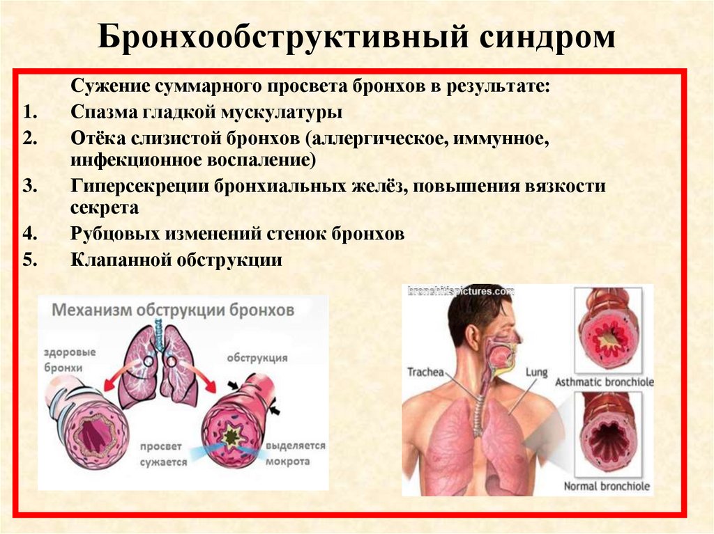 Бронхообструктивный синдром презентация казакша