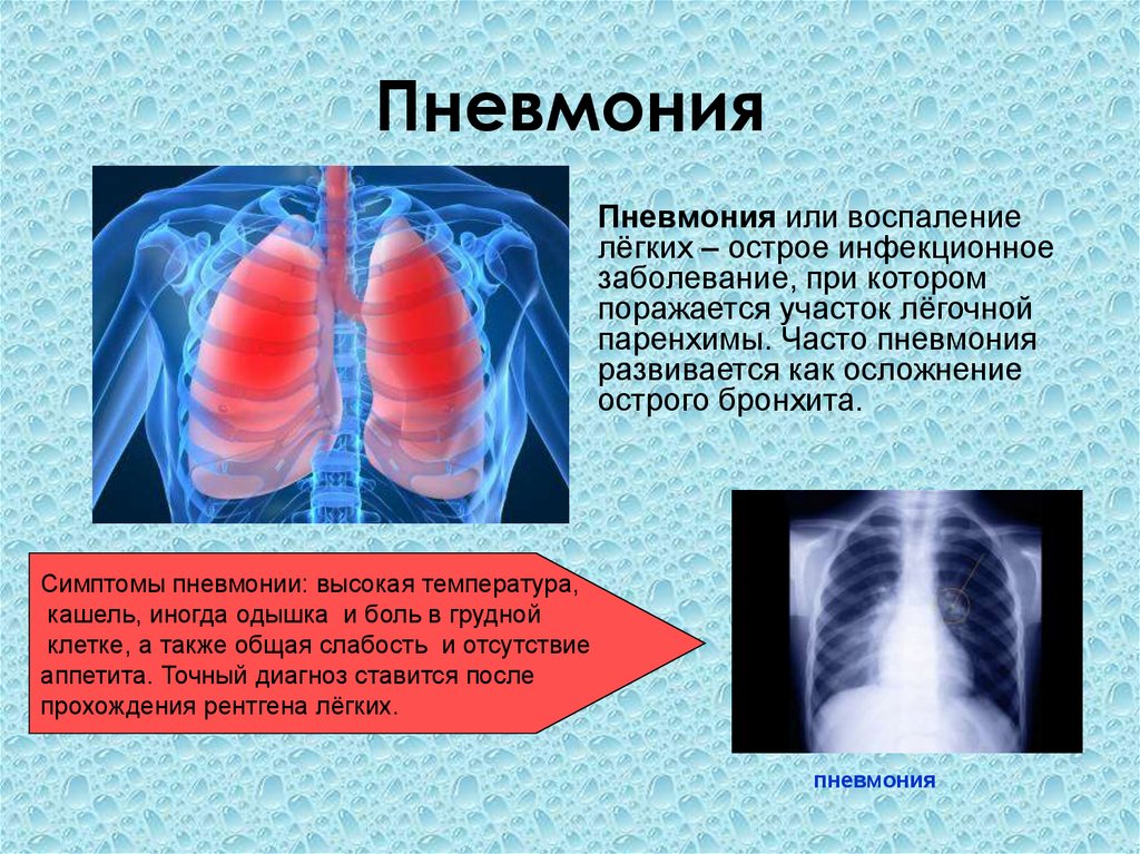 Пневмония легких опасно