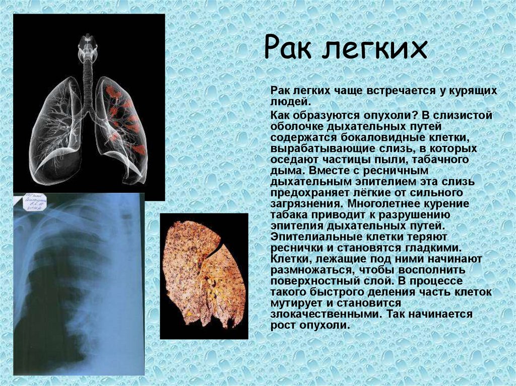 Рак легких отзывы пациентов. Заболевания органов дыхания. Онкологические заболевания легких. Заболевание легких сообщение.