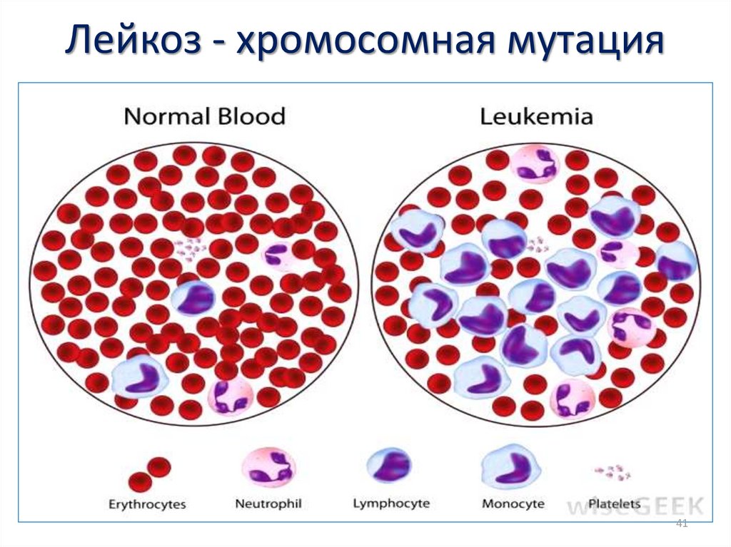 Примеры лейкозов. Мутация клеток крови. Лейкоз Тип мутации.