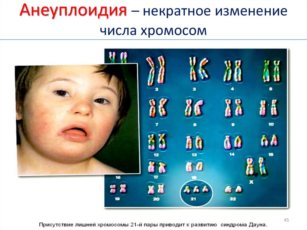Изменение формы хромосом. Синдром Дауна анеуплоидия. Анеуплоидия хромосомы. Хромосомные болезни анеуплоидия.