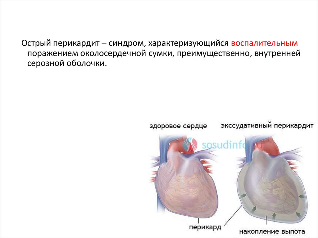 Преимущественное поражение сердца