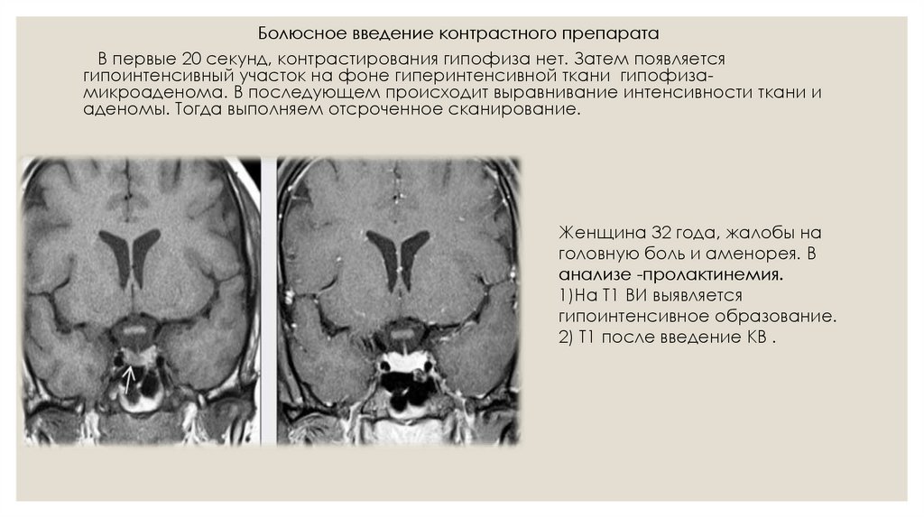 Мр картина микроаденома гипофиза