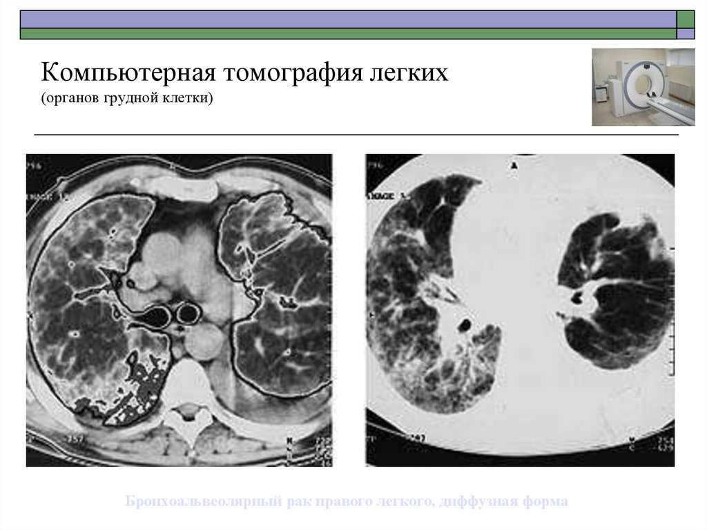 Диффузный рак легких. Бронхоальвеолярная карцинома на кт. Компьютерная томография легких. Компьютерная томография грудной клетки. Формы карцином легкого на кт.