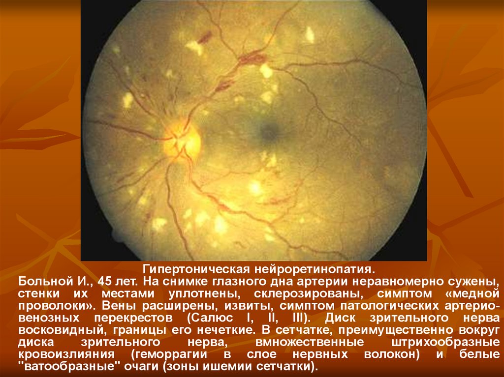 Сужение сосудов глаз. Гипертоническая ретинопатия глазное дно. Гипертоническая нейроретинопатия глазное дно. Почечная ретинопатия сетчатки. Почечная ретинопатия глазное дно.