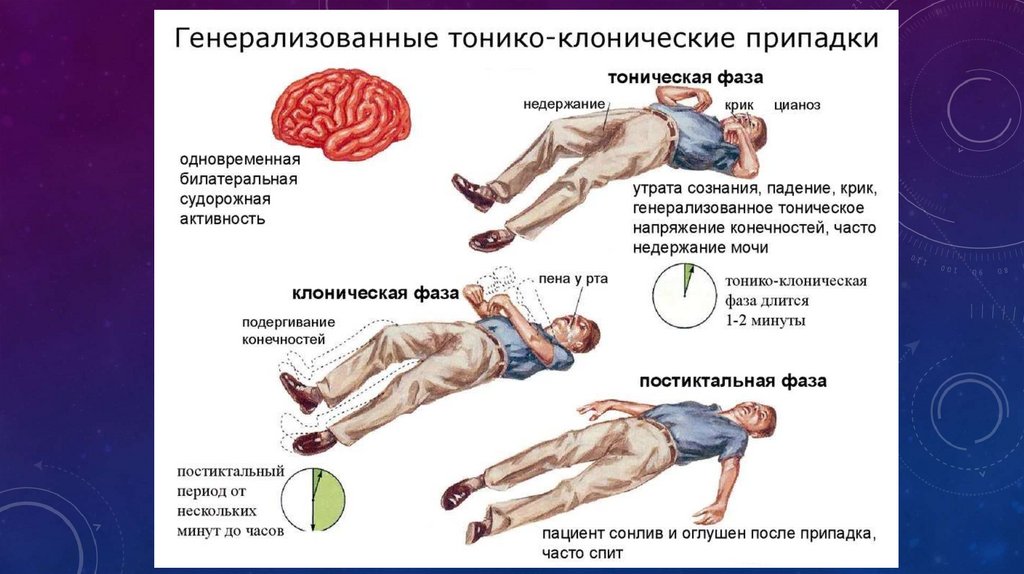 Эпилепсия презентация казакша