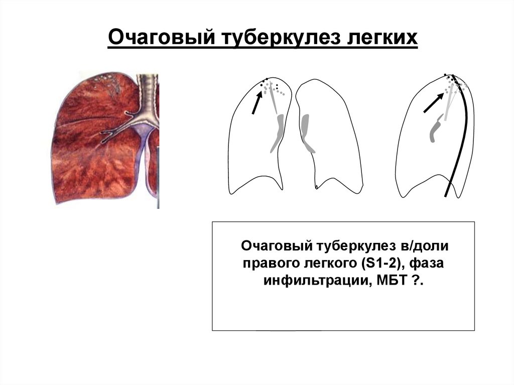 Очаговая форма туберкулеза