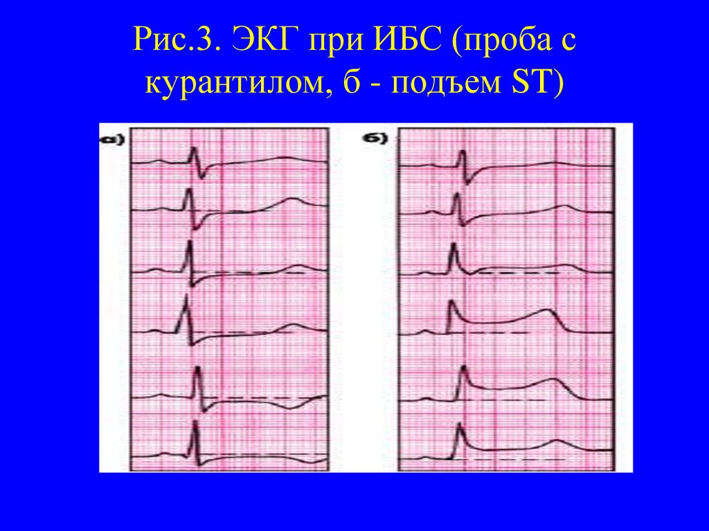 Экг 3. Проба с эргометрином при стенокардии. ЭКГ заключение стенокардия. Как выглядит кардиограмма при ИБС. Атеросклероз на ЭКГ.