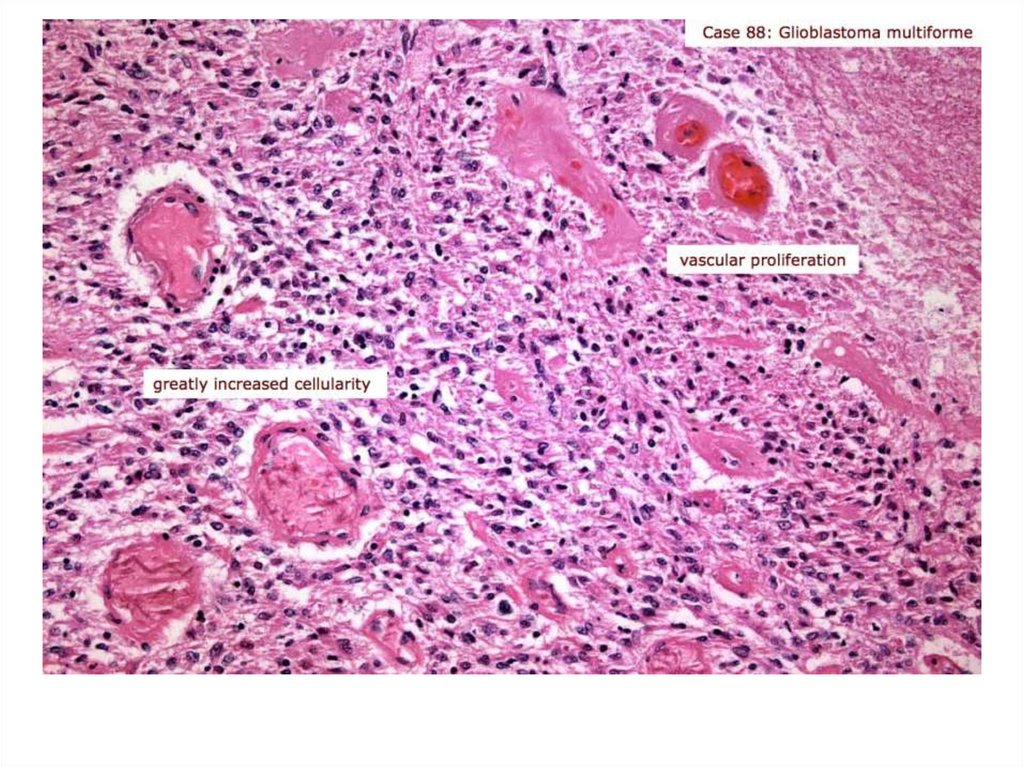 Пауков патологическая анатомия. Мультиформная глиобластома микропрепарат. Глиобластома головного мозга гистология. Глиобластома головного мозга микропрепарат. Мультиформная глиобластома гистология.