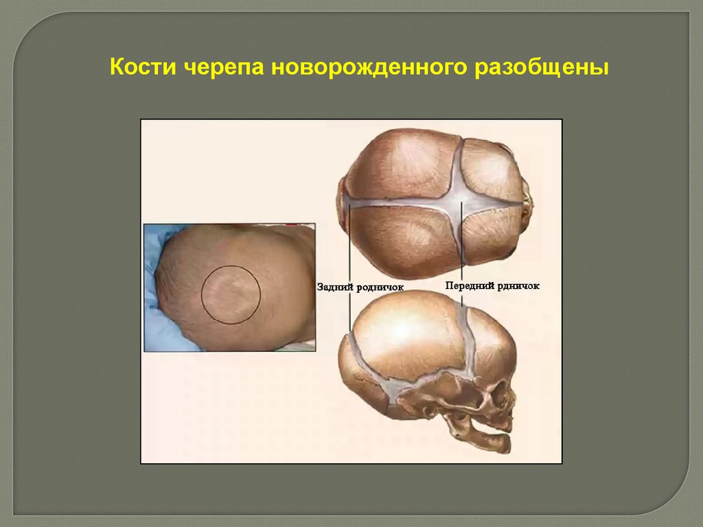 Задний родничок. Кости черепа новорожденного. Череп новорожденного анатомия. Соединения костей черепа новорожденного.