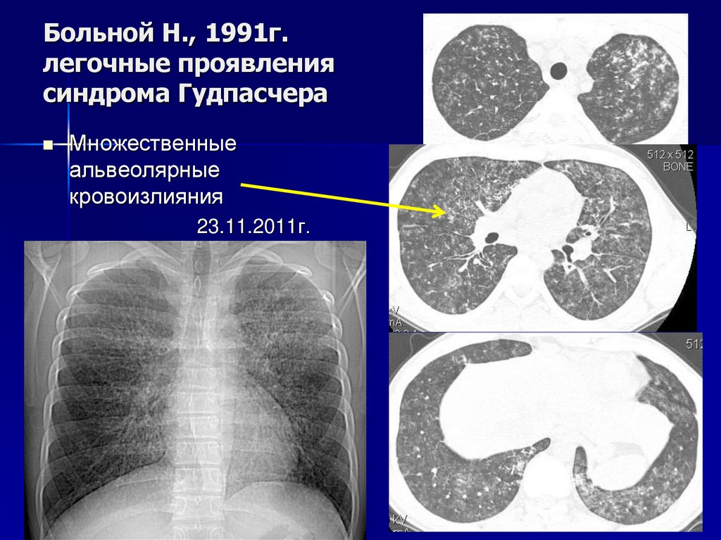 Клиническая картина осложненной формы гипертонического криза с поражением сосудов