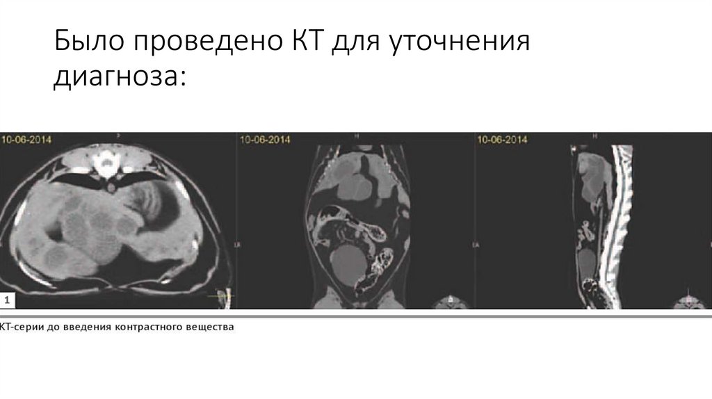 Было проведено КТ для уточнения диагноза: