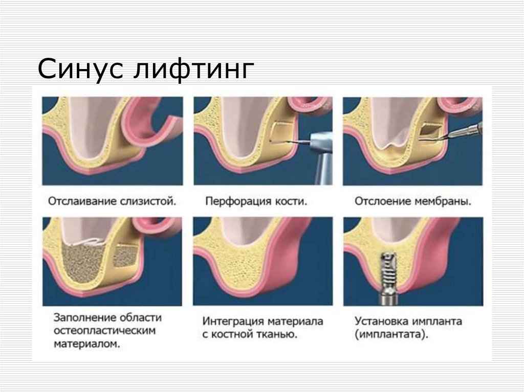 Синус лифтинг в стоматологии что это