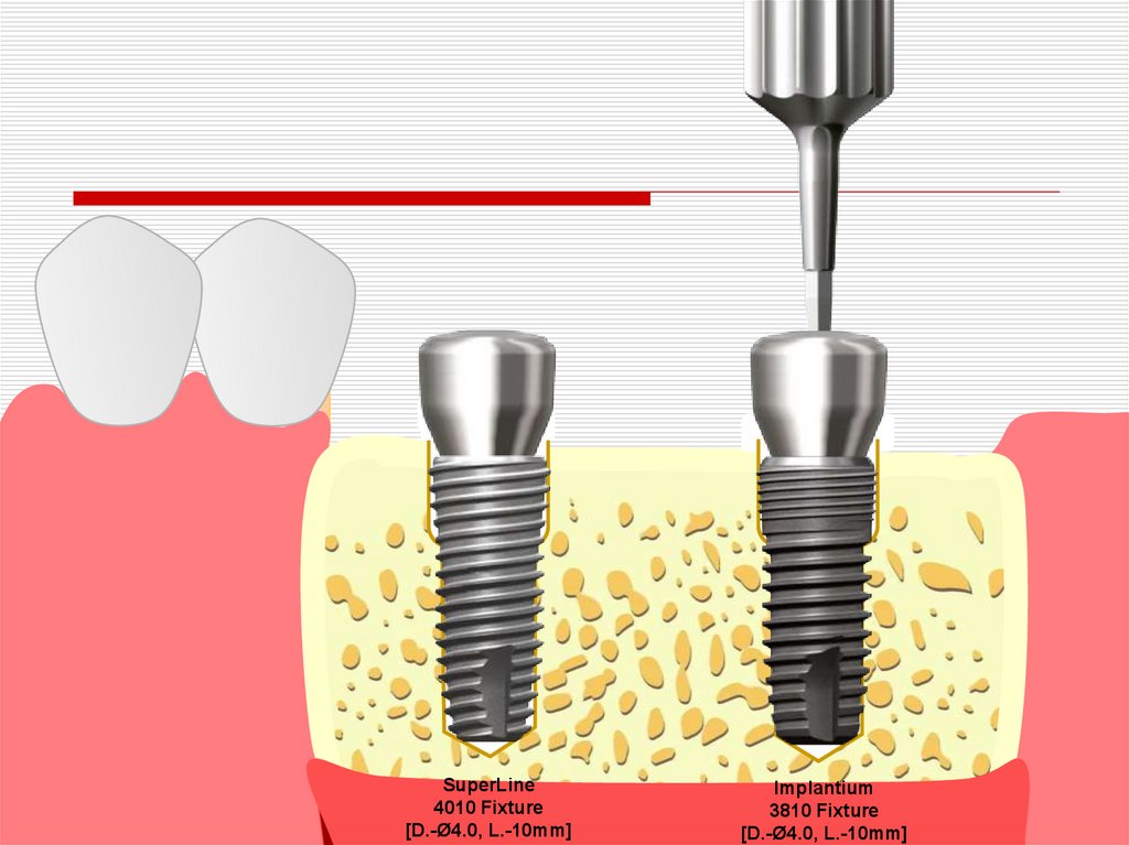 Имплантационный набор дентиум фото