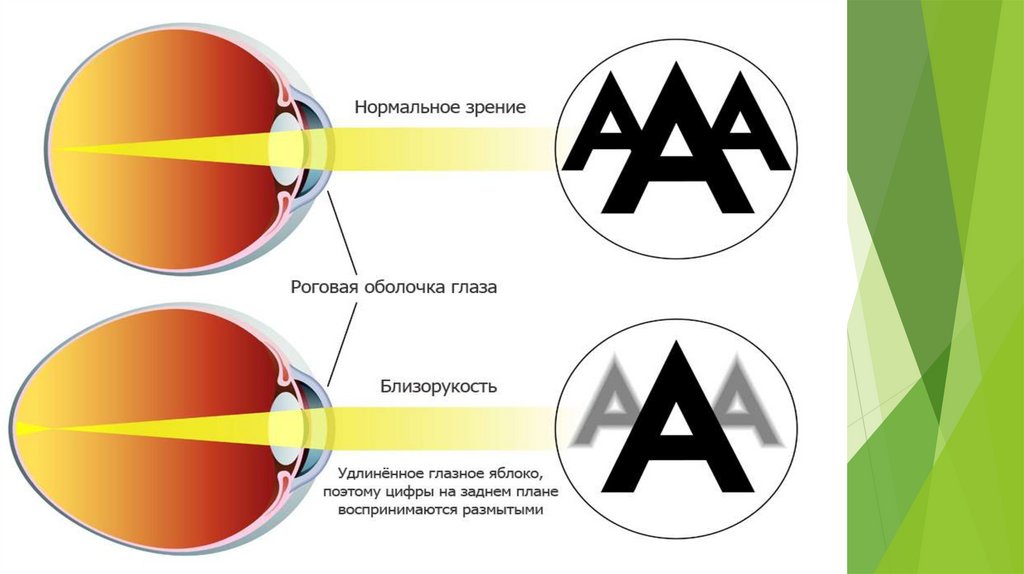 Презентация по теме миопия