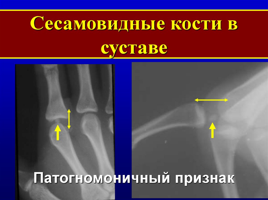 Сесамовидные кости