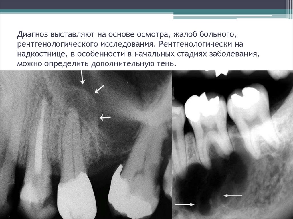 Периостит классификация