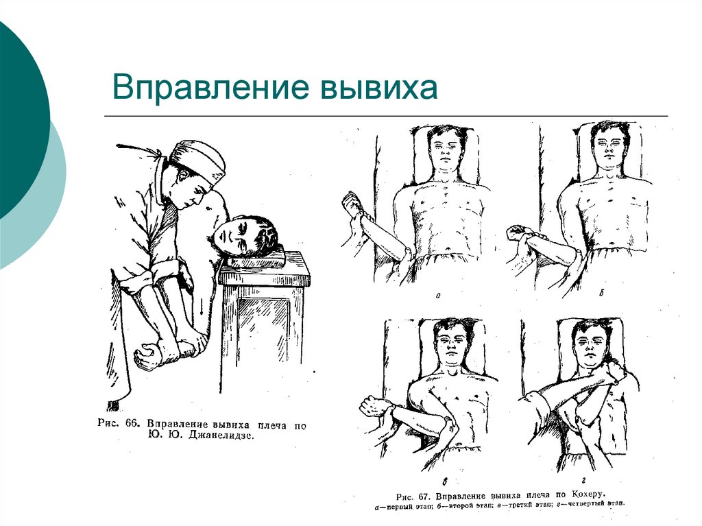 Привычный вывих плеча презентация