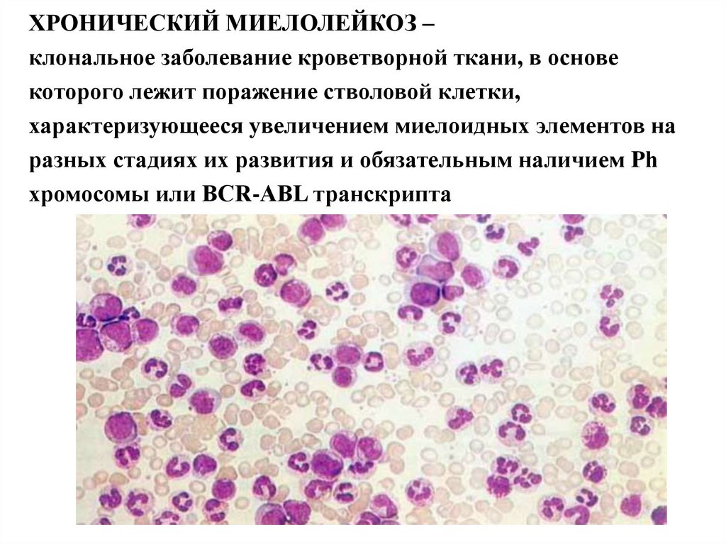 Миеломоноцитарный лейкоз картина крови