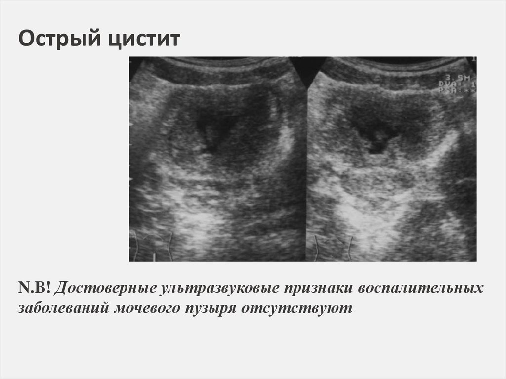 Семиотика урологических заболеваний презентация