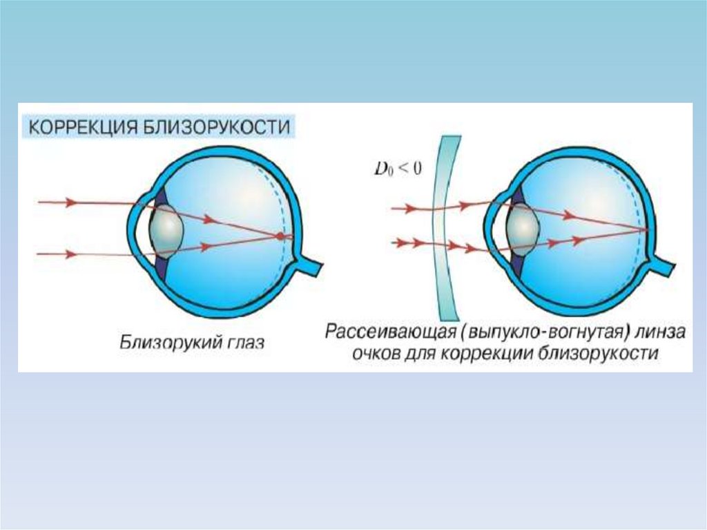 Коррекция зрения миопия. Линзы для глаз для зрения близорукость. Дефекты зрения. Дефекты зрения физика. Изображение даваемое глазом.