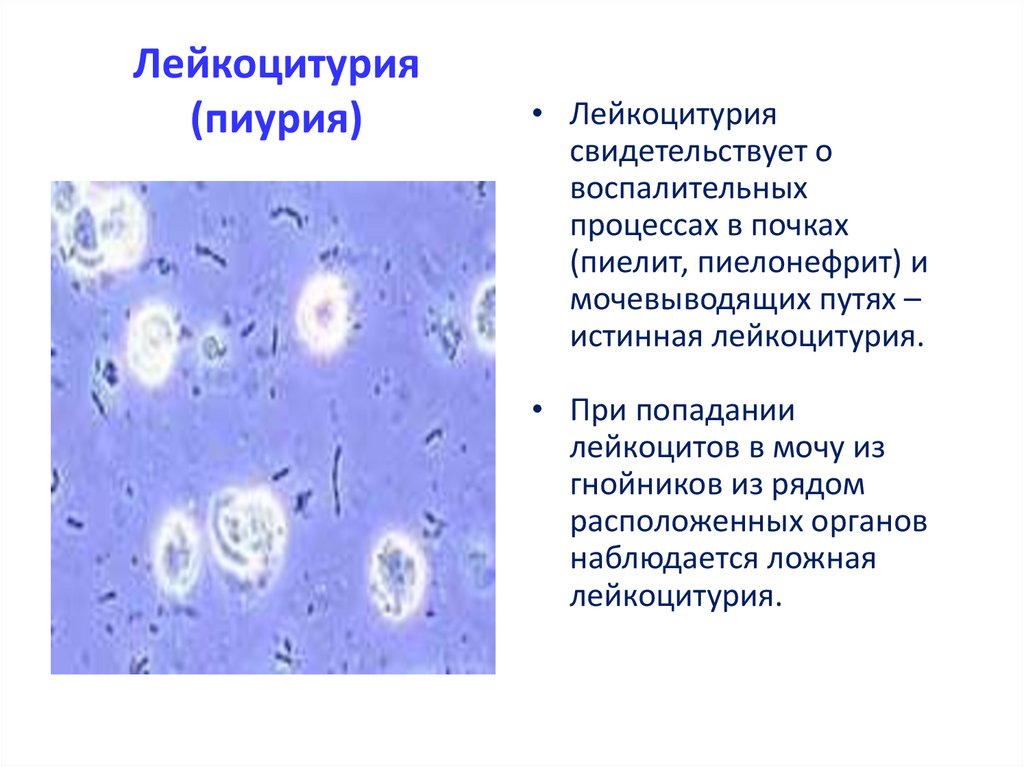 Лейкоциты в моче заболевания. Лейкоцитурия механизм развития. Ложная лейкоцитурия. Пиелонефрит лейкоцитурия. Пиурия классификация.