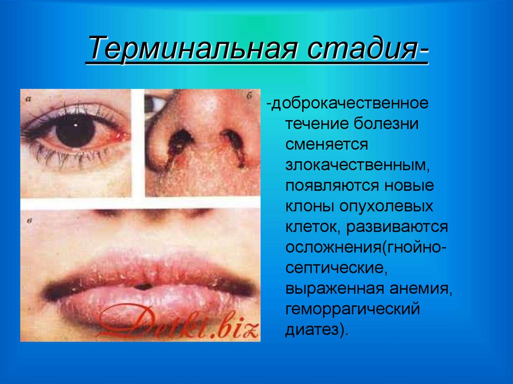 Терминальная стадия-