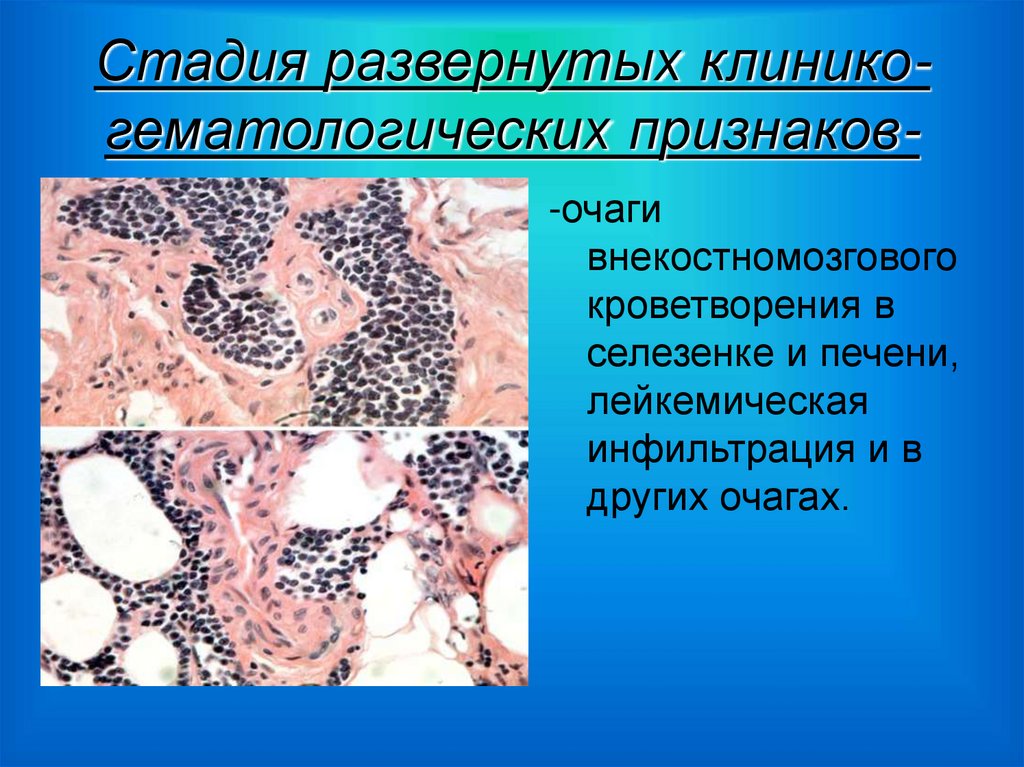 Стадия развернутых клинико-гематологических признаков-