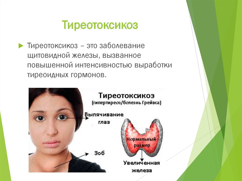 Заболевание при избытке гормона щитовидной железы. Патология щитовидной железы. Гипертиреоз щитовидной железы. Гипертиреоз гормоны щитовидной железы.