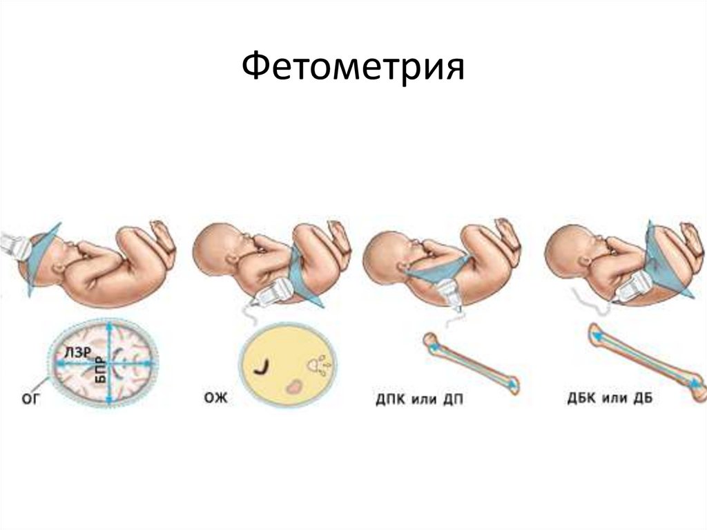 Фетометрия. БПР плода. Ультразвуковая фетометрия плода. Бипариетальный размер плода по неделям.