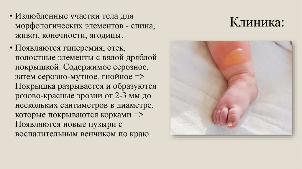 Везикулопустулез у новорожденных