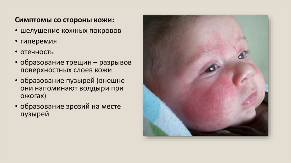 Псевдофурункулез новорожденных фото